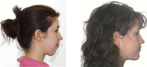 Before and after comparison of surgical orthodontics patient